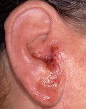 Outer ear infection redness
