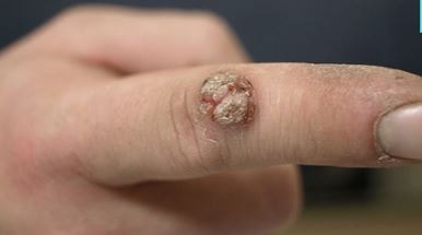 Warts on finger