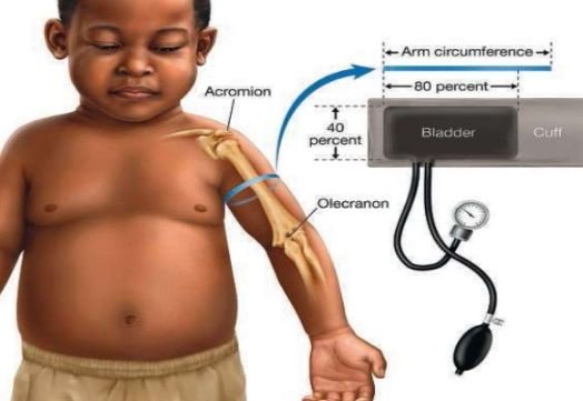 hemodynamic instability - blood pressure recording