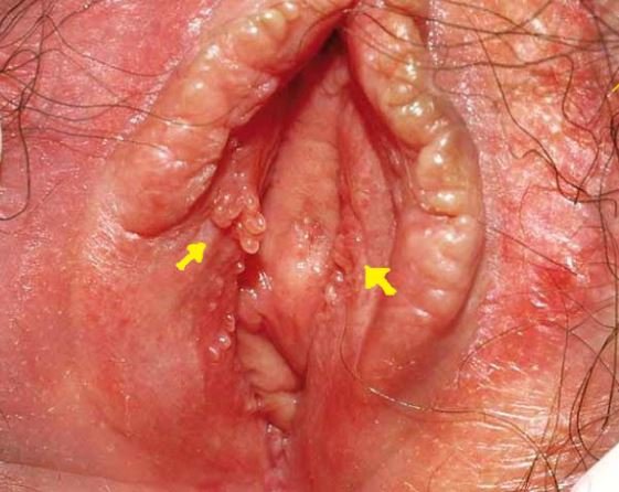 Genital warts: MedlinePlus Medical Encyclopedia