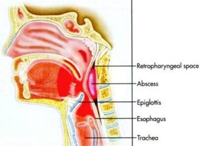 Retropharyngeal Abscess Lateral View