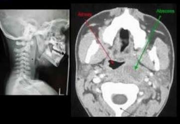 Retropharyngeal Abscess MRI