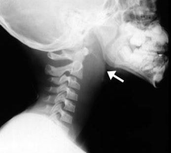 Retropharyngeal Abscess X Ray