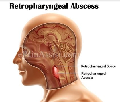 Retropharyngeal Abscess