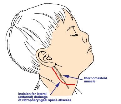 Retropharyngeal space Abscess drainage
