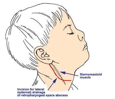 Retropharyngeal space Abscess drainage