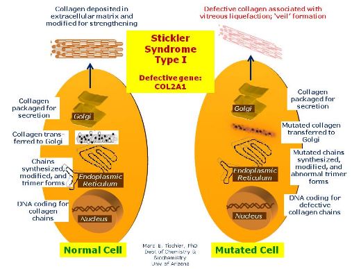 Stickler Syndrome pathogenesis