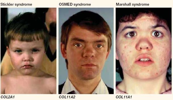 Stickler Syndrome types