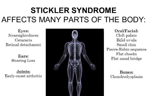 Stickler syndrome body organs