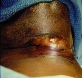 Thyroglossal duct cyst image
