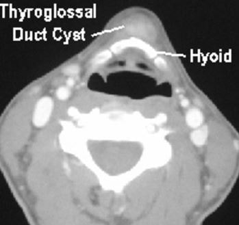 Thyroglossal duct cyst photo