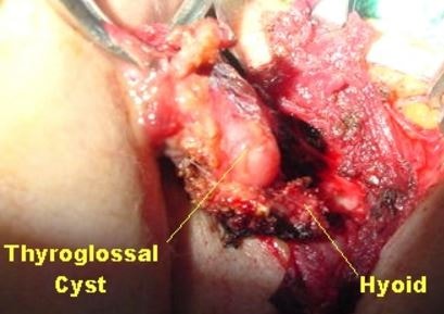 Thyroglossal duct cyst Surgery