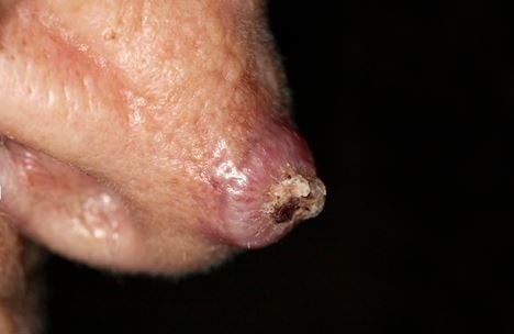 keratoacanthoma image 10