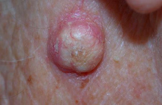 keratoacanthoma pictures