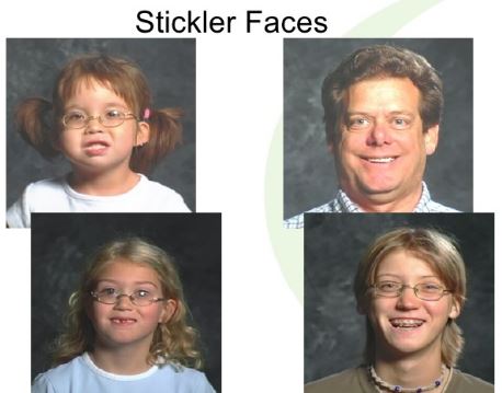 stickler syndrome picture