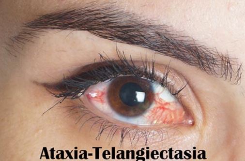 ataxia-telangectasia