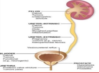 hydronephrosis-causes