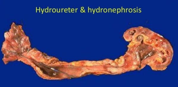 hydroureter-hydronephrosis