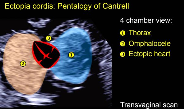 pentalogy of cantrell