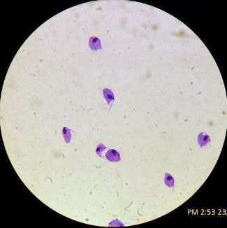 Trichomonas Vaginalis