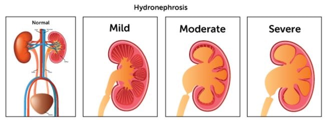 hydronephrosis-mild-moderate-severe