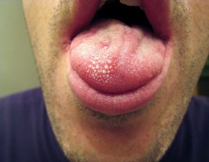 warts on tongue-symptoms
