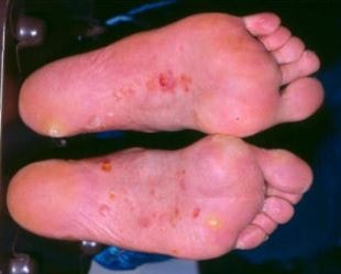 blisters on feet pictures #10