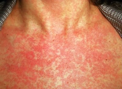 rubella rash-photos-pics