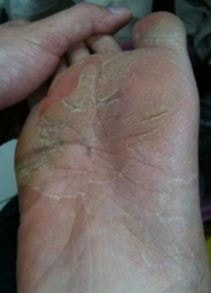 foot-fungus-picture