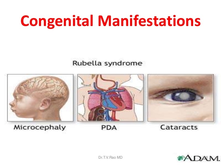 rubella-during-pregnancy-congential-malformations