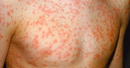 rubella rash-picture-image