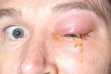 eye cellulitis