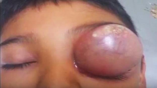 eye cellulitis