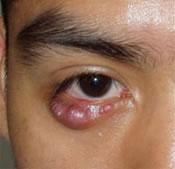 Image result for eye chalazion