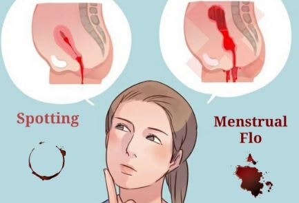 spotting between periods picture-vs-bleeding