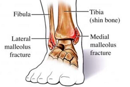 ankle-joint-medial Malleolus fracture