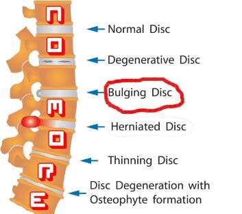 Bulging Disc
