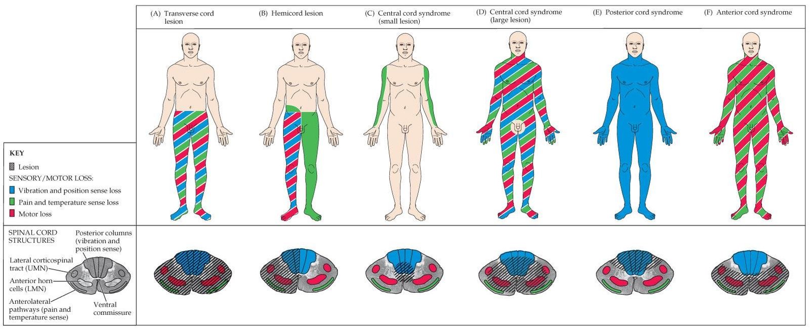 Central Cord Syndrome lesion Symptoms Spinal cord