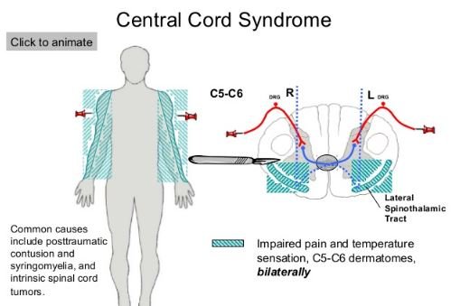 Central Cord Syndrome