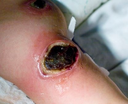 Ecthyma Gangrenosum Image