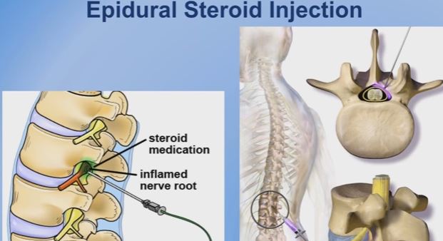 epidural-steroid-injection for stenosis