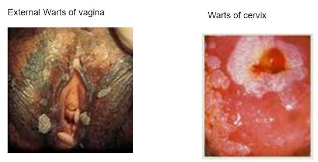 External warts of vagina genital