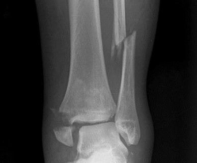 Fibula fracture x ray