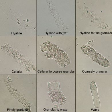 hyaline casts in urine