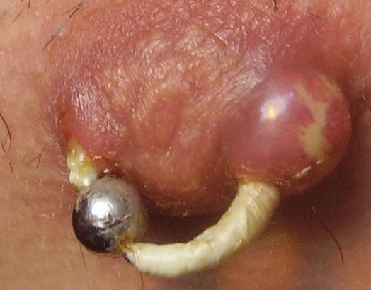 Infected Nipple Piercing Pus