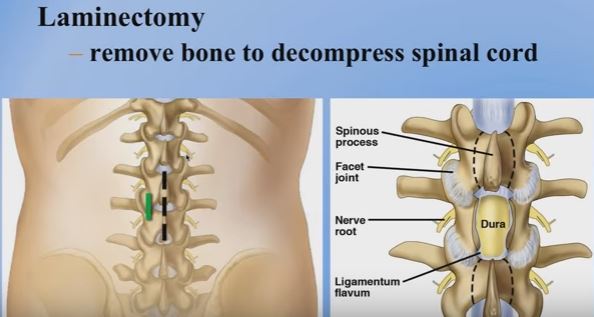 laminectomy-for-lumbar-spinal-stenosis