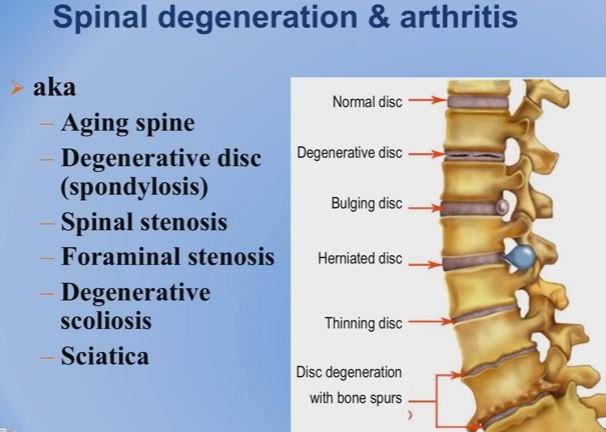 lumbar-spinal-stenosis