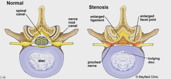 Lumbar Spinal Stenosis-vs-normal-vertebrae