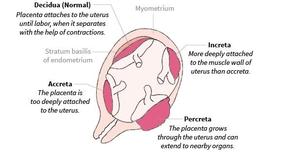 placenta-percreta-definition-symptoms-signs-treatment-diagnosis