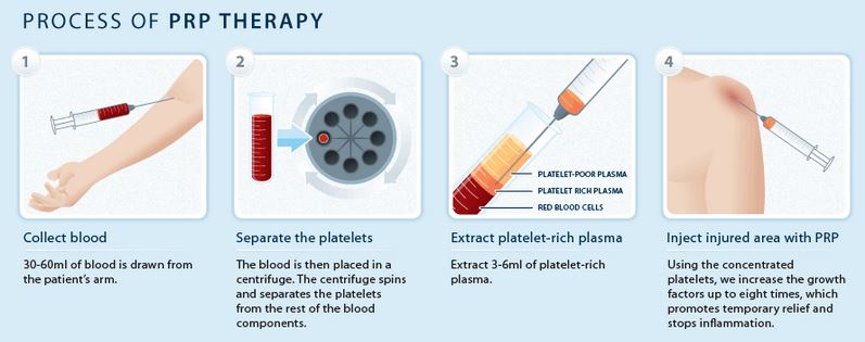 Platelet Rich Plasma Therapy for alopecia